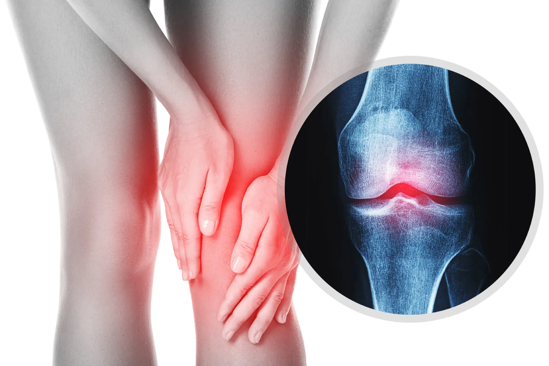 Osteoarthritis: Symptoms, Causes, Treatment & Natural Remedies - Blumen ...