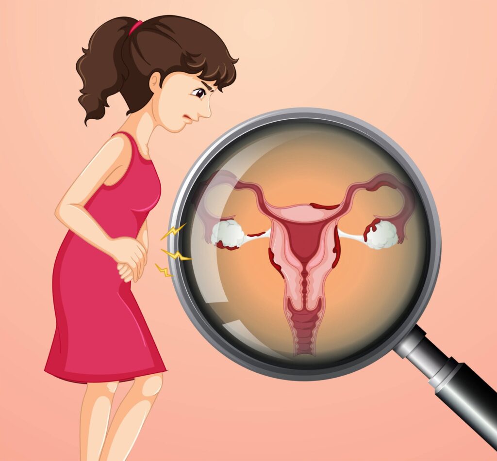 Bacterial Vaginosis