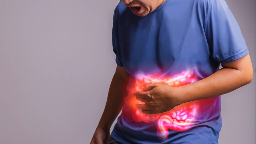 Irritable Bowel Syndrome