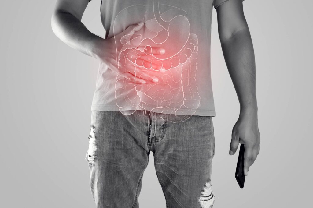 ulcerative colitis