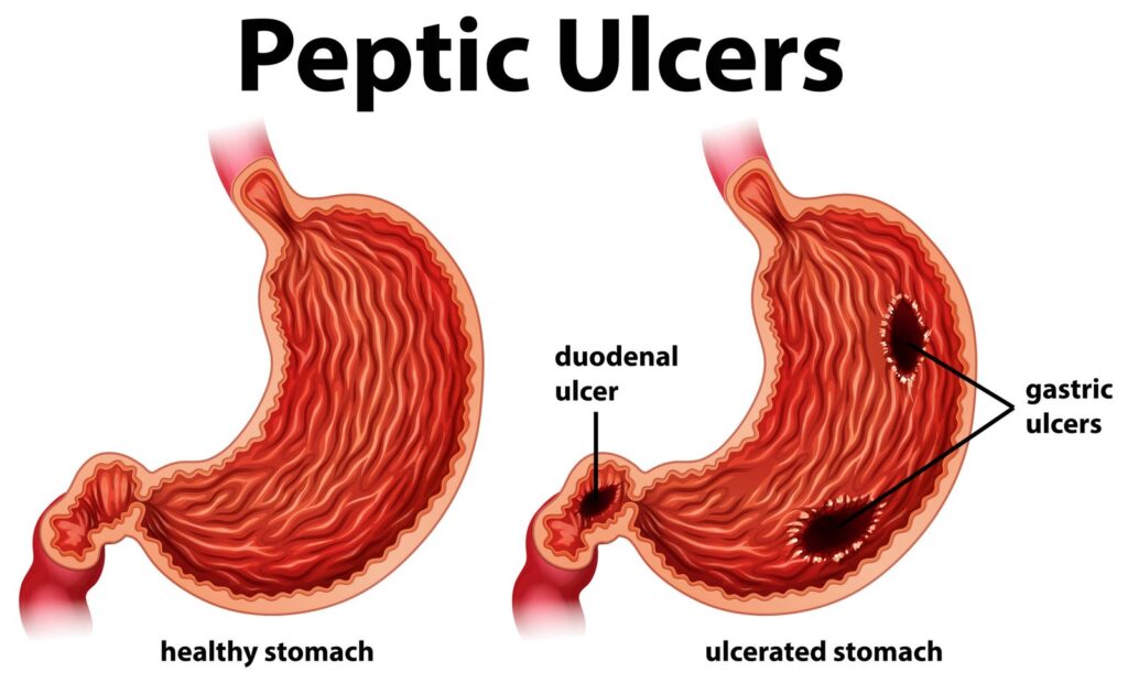Peptic Ulcers